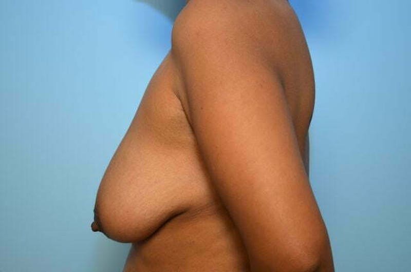 Breast Lift with Augmentation Before & After Gallery - Patient 870058 - Image 9