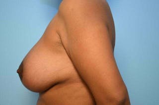 Breast Lift with Augmentation Before & After Gallery - Patient 870058 - Image 10