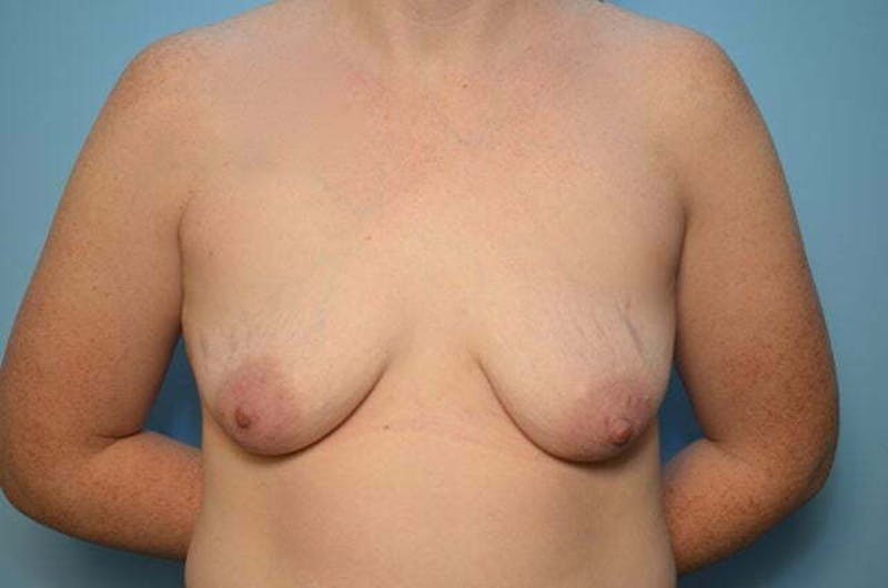 Breast Lift with Augmentation Before & After Gallery - Patient 222364 - Image 1