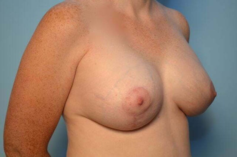 Breast Lift with Augmentation Before & After Gallery - Patient 222364 - Image 4