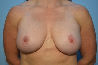 Breast Lift with Augmentation Before & After Gallery - Patient 264638 - Image 2
