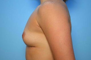 Breast Implant Removal Before & After Gallery - Patient 318173 - Image 10