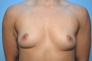 Breast Implant Removal Before & After Gallery - Patient 318173 - Image 2