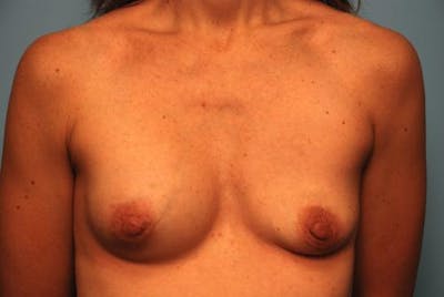 Breast Implant Removal Before & After Gallery - Patient 355778 - Image 1