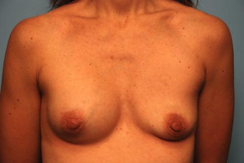 Breast Implant Removal Before & After Gallery - Patient 355778 - Image 1