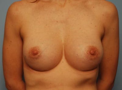 Breast Implant Removal Before & After Gallery - Patient 355778 - Image 2