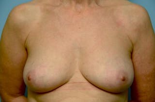 Breast Implant Removal Before & After Gallery - Patient 412816 - Image 2