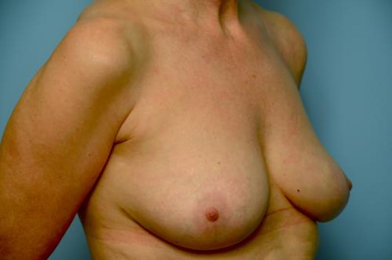 Breast Implant Removal Before & After Gallery - Patient 412816 - Image 4