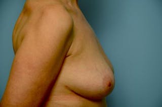 Breast Implant Removal Before & After Gallery - Patient 412816 - Image 6