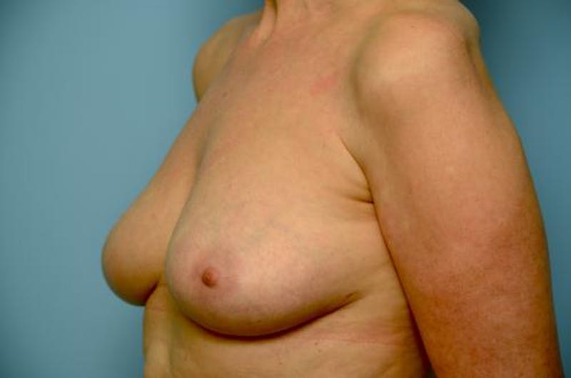 Breast Implant Removal Before & After Gallery - Patient 412816 - Image 8
