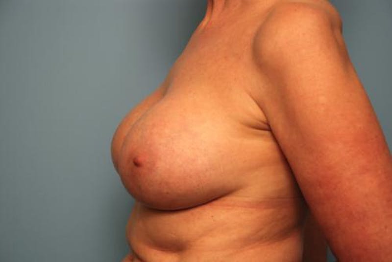 Breast Implant Removal Before & After Gallery - Patient 412816 - Image 9