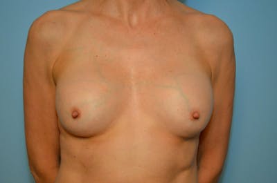 Breast Implant Removal Before & After Gallery - Patient 293731 - Image 1