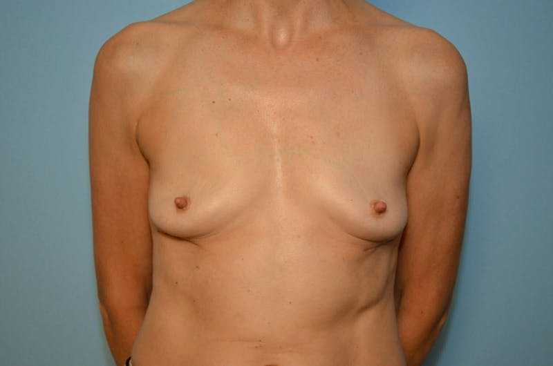 Breast Implant Removal Before & After Gallery - Patient 293731 - Image 2