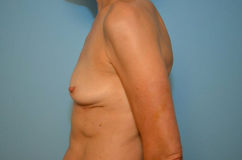 Breast Implant Removal Before & After Gallery - Patient 293731 - Image 10