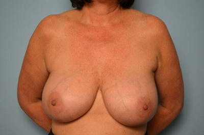 Breast Implant Removal Before & After Gallery - Patient 147713 - Image 1