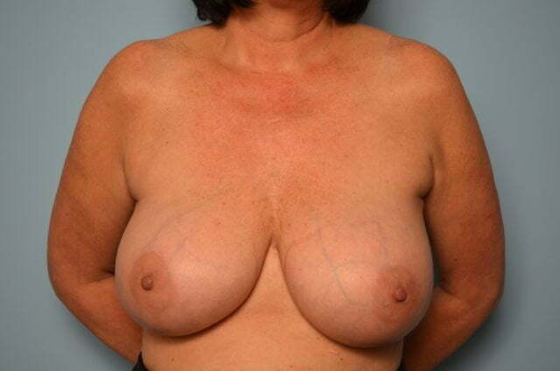 Breast Implant Removal Before & After Gallery - Patient 147713 - Image 1