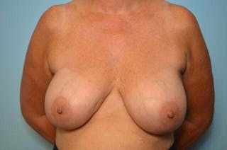 Breast Implant Removal Before & After Gallery - Patient 147713 - Image 2