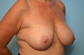Breast Implant Removal Before & After Gallery - Patient 147713 - Image 4