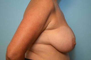 Breast Implant Removal Before & After Gallery - Patient 147713 - Image 6