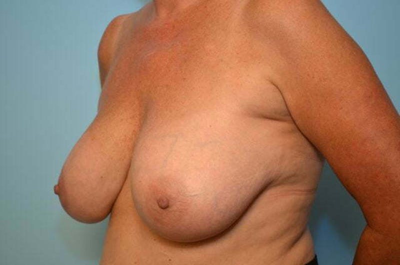 Breast Implant Removal Before & After Gallery - Patient 147713 - Image 8