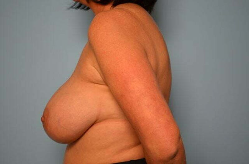 Breast Implant Removal Before & After Gallery - Patient 147713 - Image 9