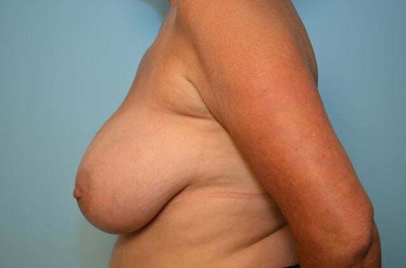 Breast Implant Removal Before & After Gallery - Patient 147713 - Image 10