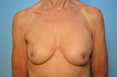 Breast Implant Removal Before & After Gallery - Patient 379009 - Image 1