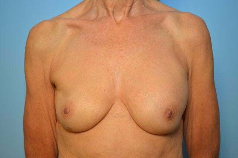 Breast Implant Removal Before & After Gallery - Patient 379009 - Image 1