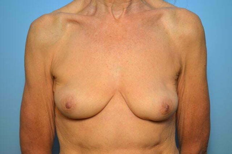 Breast Implant Removal Before & After Gallery - Patient 379009 - Image 2