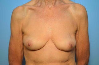 Breast Implant Removal Before & After Gallery - Patient 379009 - Image 2
