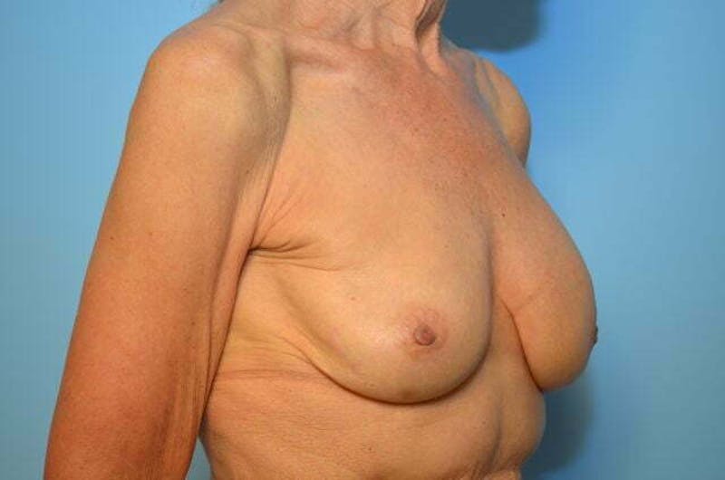 Breast Implant Removal Before & After Gallery - Patient 379009 - Image 3