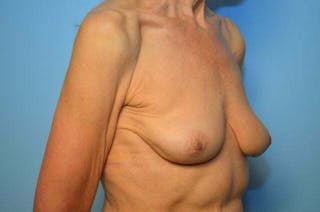 Breast Implant Removal Before & After Gallery - Patient 379009 - Image 4