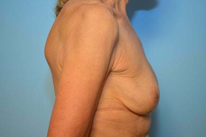 Breast Implant Removal Before & After Gallery - Patient 379009 - Image 5