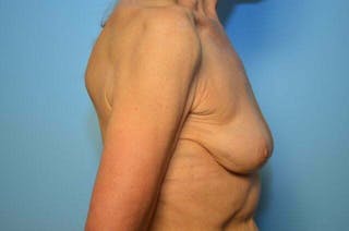 Breast Implant Removal Before & After Gallery - Patient 379009 - Image 6