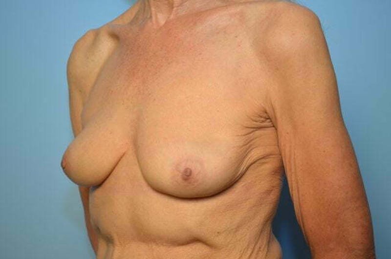 Breast Implant Removal Before & After Gallery - Patient 379009 - Image 8