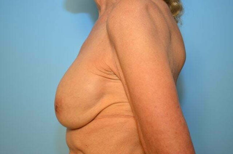 Breast Implant Removal Before & After Gallery - Patient 379009 - Image 9