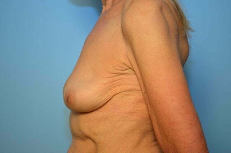 Breast Implant Removal Before & After Gallery - Patient 379009 - Image 10