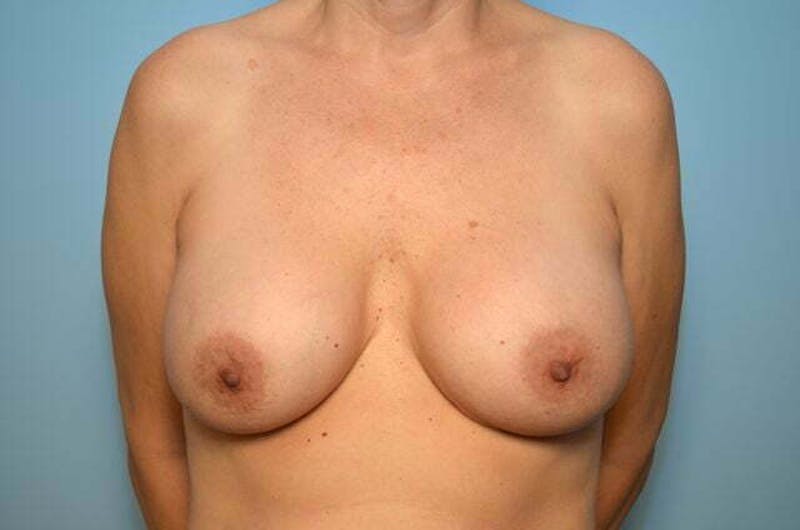 Breast Implant Removal Before & After Gallery - Patient 236024 - Image 1