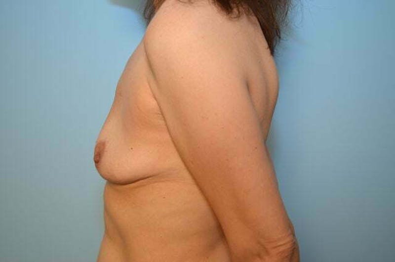 Breast Implant Removal Before & After Gallery - Patient 236024 - Image 10