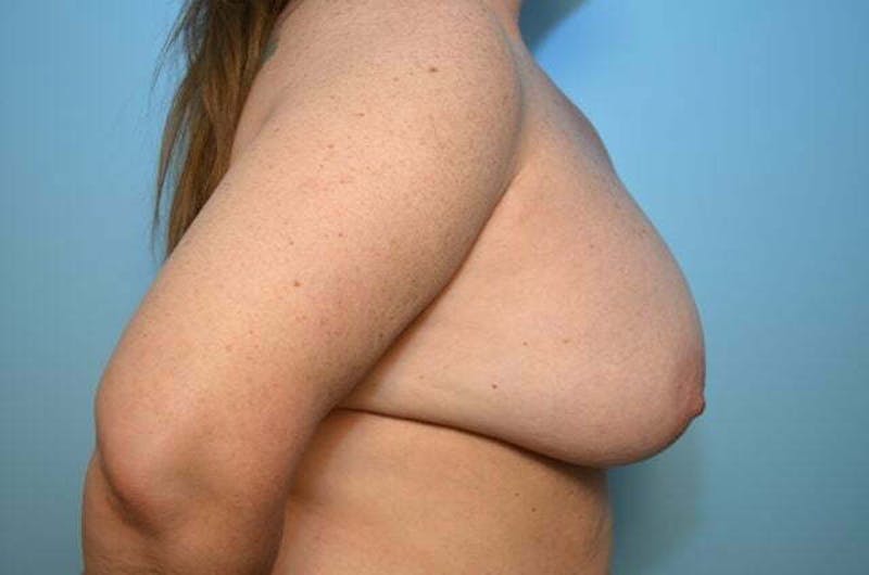 Breast Implant Removal Before & After Gallery - Patient 261434 - Image 5