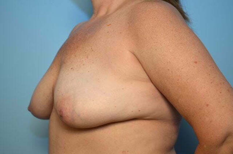 Breast Implant Removal Before & After Gallery - Patient 261434 - Image 8