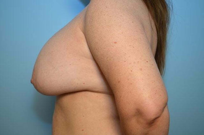 Breast Implant Removal Before & After Gallery - Patient 261434 - Image 9