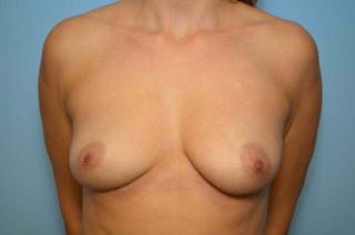 Breast Implant Removal Before & After Gallery - Patient 158619 - Image 2