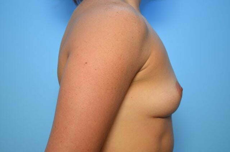 Breast Implant Removal Before & After Gallery - Patient 318173 - Image 6