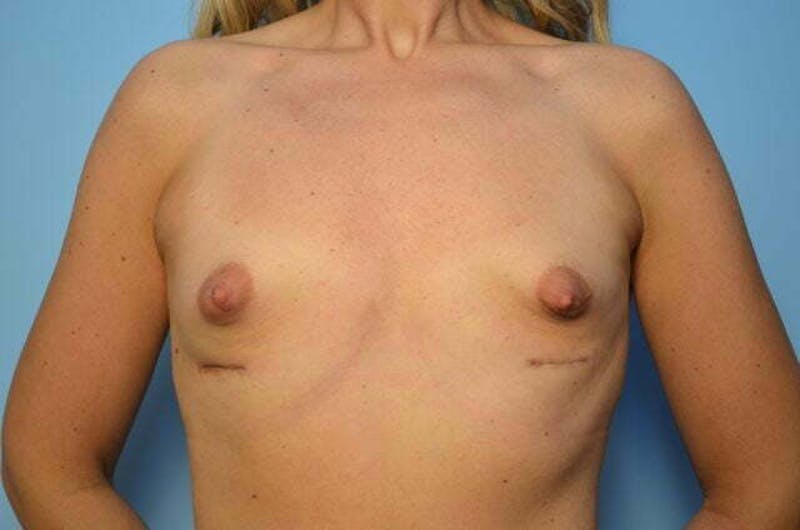 Breast Implant Removal Before & After Gallery - Patient 283383 - Image 2