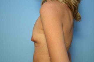 Breast Implant Removal Before & After Gallery - Patient 283383 - Image 10