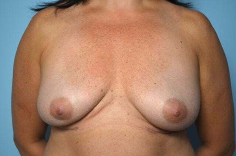 Breast Implant Removal Before & After Gallery - Patient 392048 - Image 2