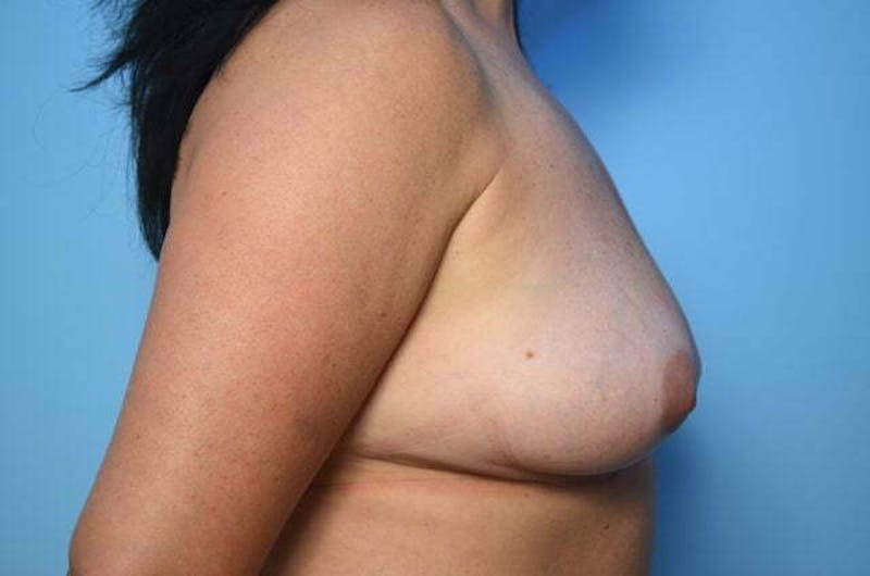 Breast Implant Removal Before & After Gallery - Patient 392048 - Image 6