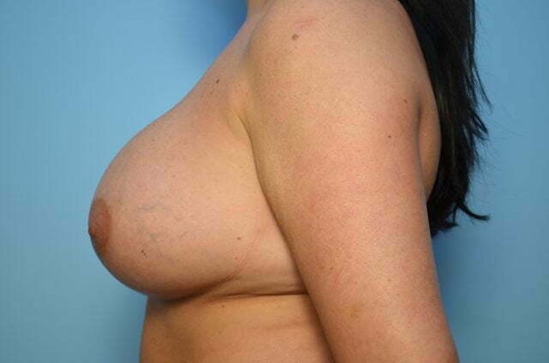 Breast Implant Removal Before & After Gallery - Patient 392048 - Image 9