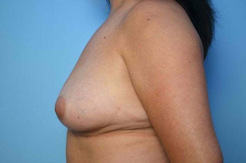 Breast Implant Removal Before & After Gallery - Patient 392048 - Image 10
